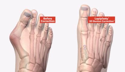 Surgery complication rates including infection and irritation from pins can go as high as 55 percent. . 3d vs 4d bunion surgery